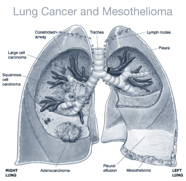 chemotherapy treatment for mesothelioma