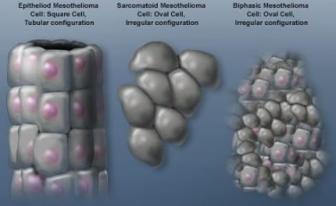 Mesothelioma Cells