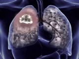 Rates of Mesothelioma cases may decrease in similar way to Lung Cancer Cases