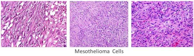 mesothelioma cells