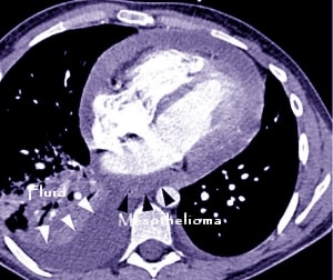 Pericardial Mesothelioma - affects the heart mesothelium